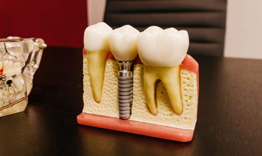 Comprehensive Guide to Dental Implants: Procedure, Benefits, and Aftercare