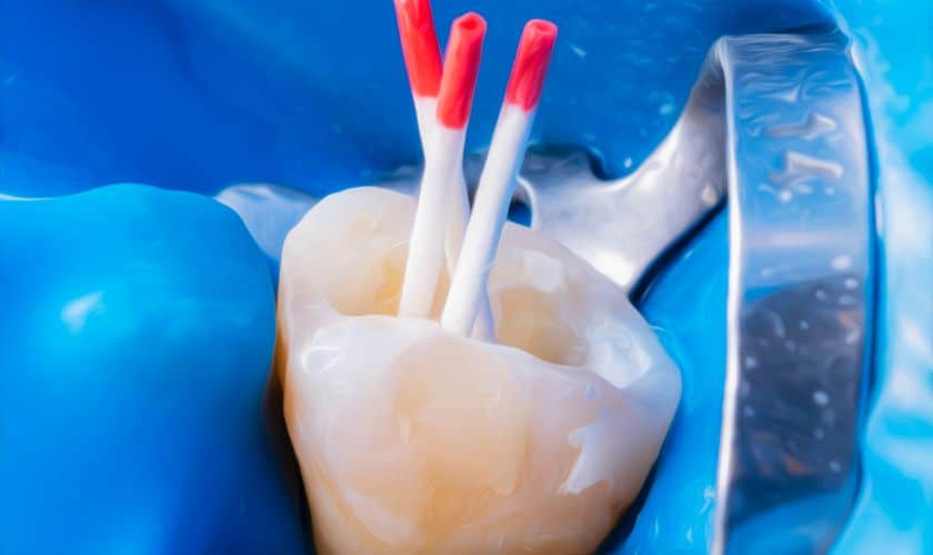 root canal therapy in Shreveport