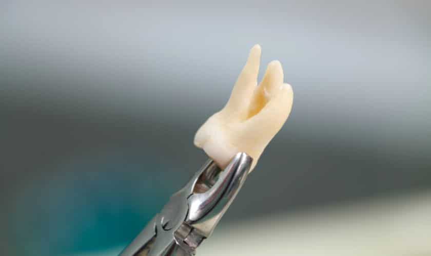Navigating Tooth Extraction: Understanding the Process and Aftercare